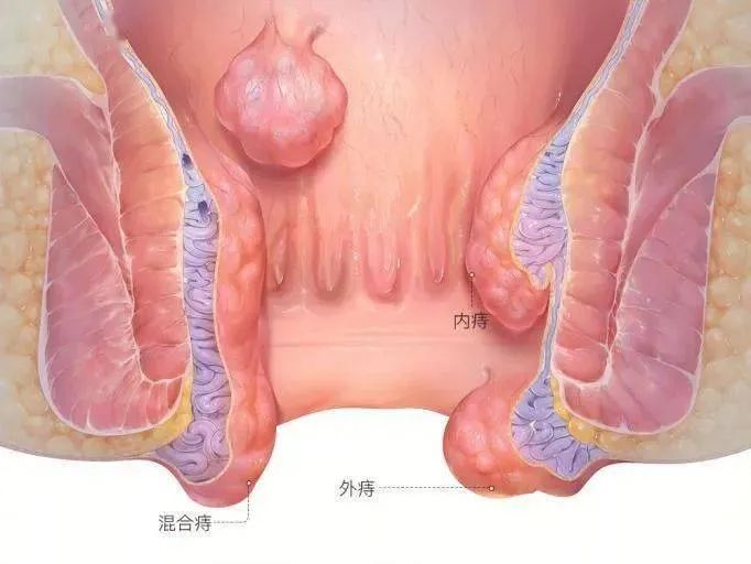 痔疮息肉图片大全图片