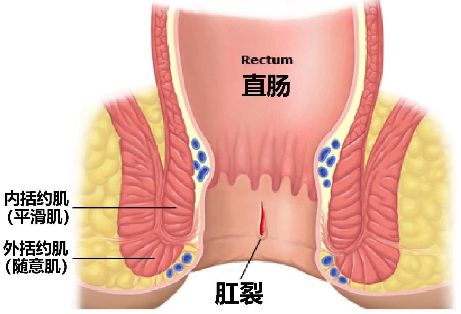 轻微肛裂图片 早期图片