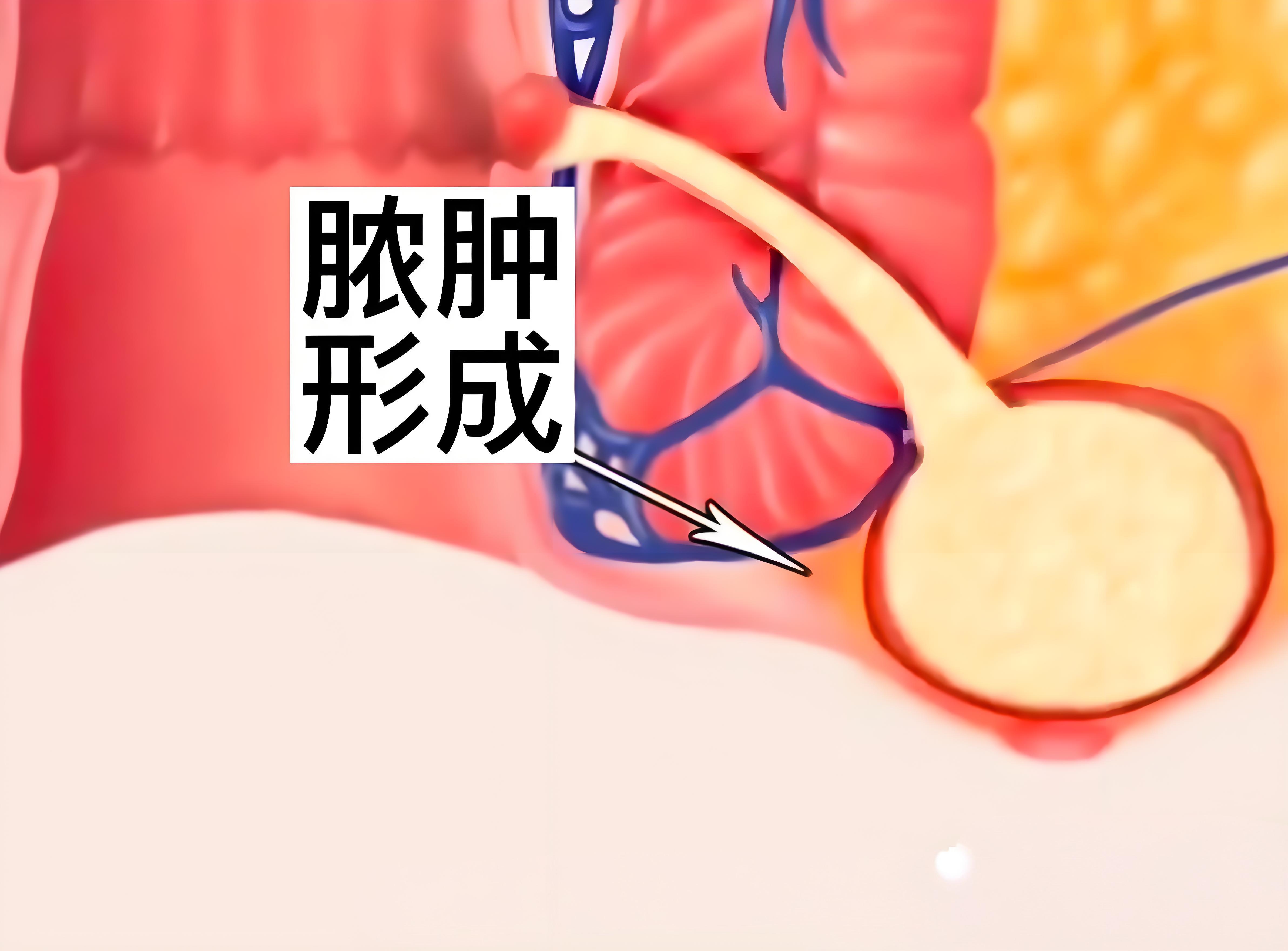 肛瘘为何是越早治越好?
