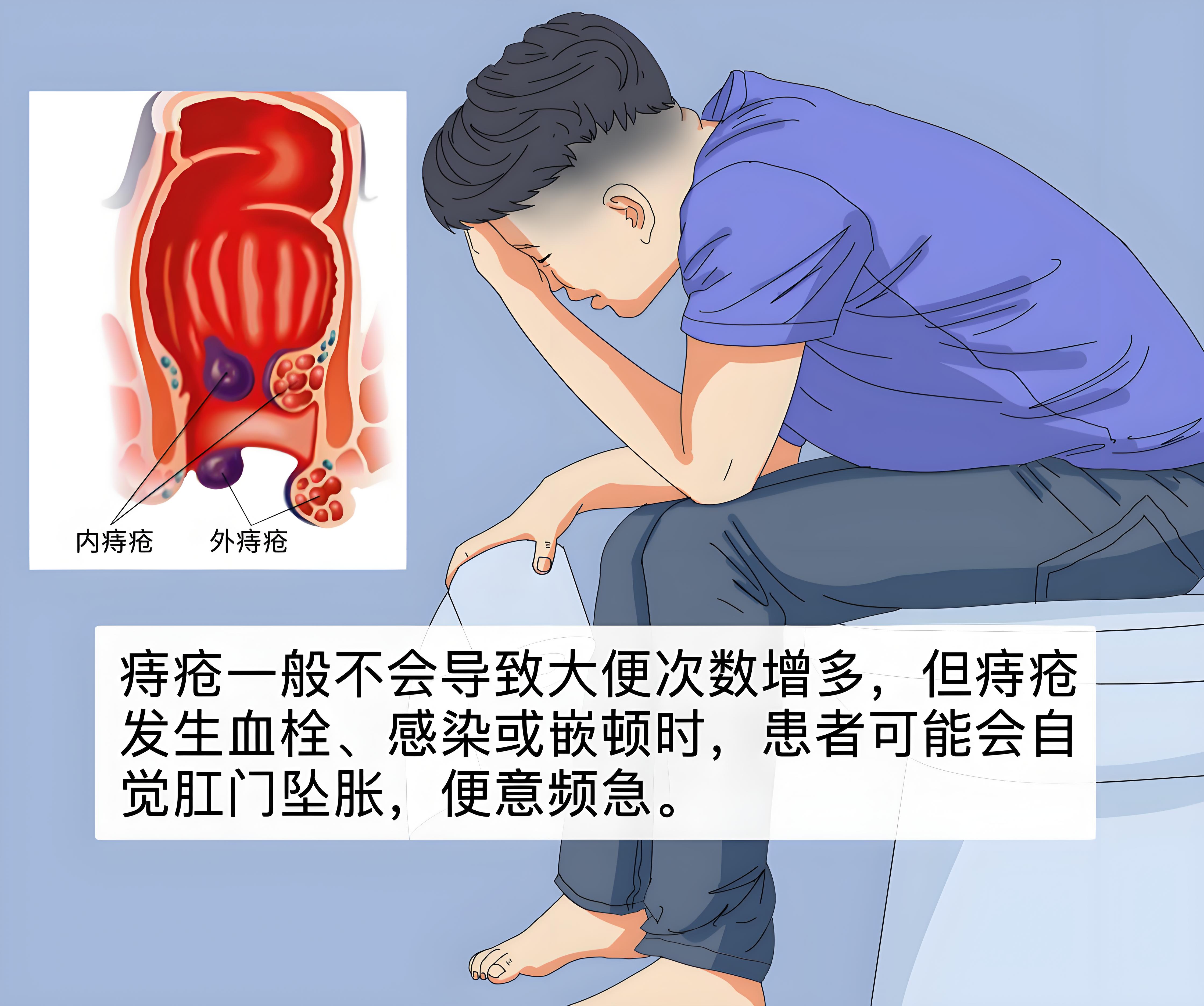 痔疮，是不是一辈子好不了? ​