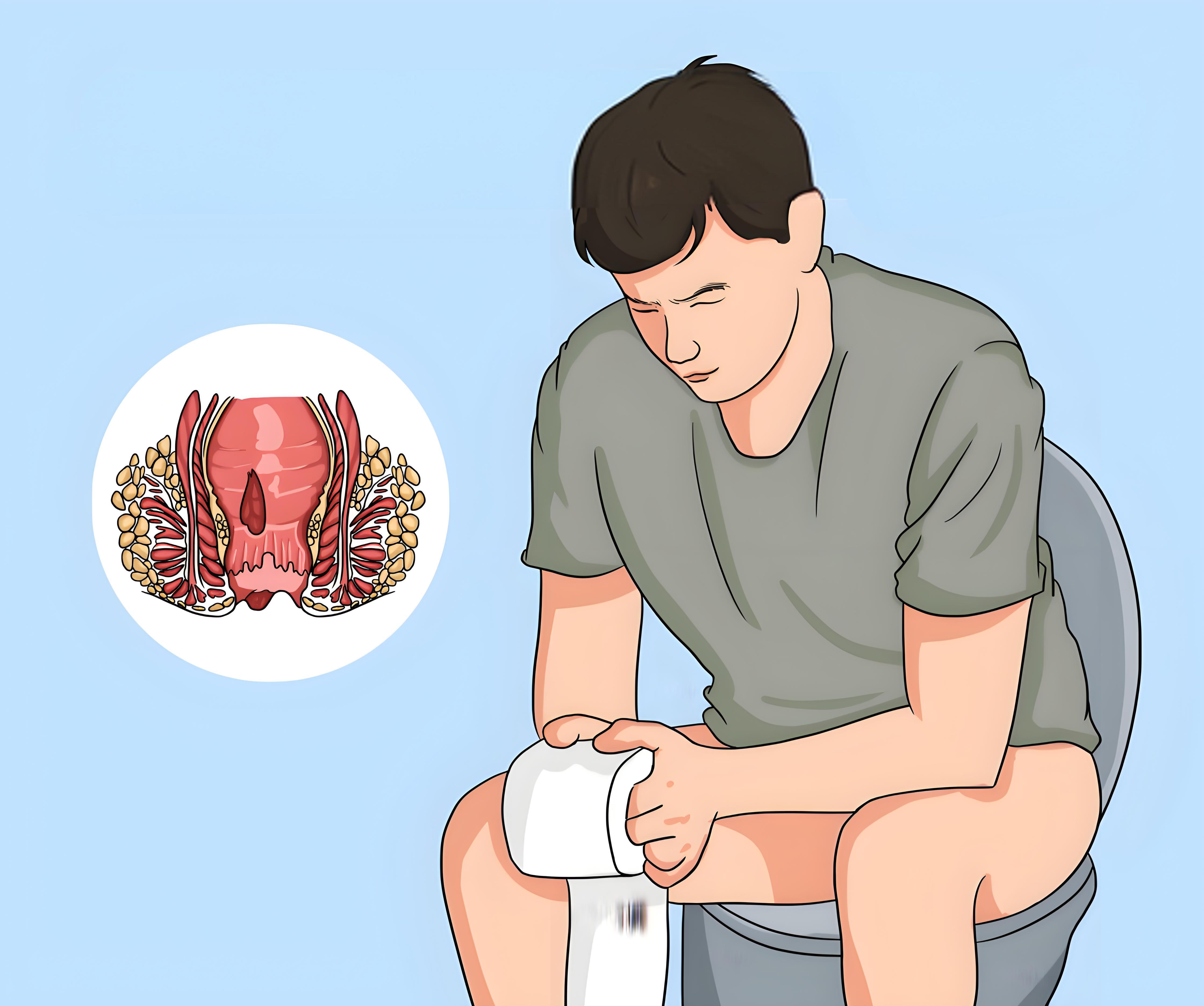 痔疮外痔肉球怎么消除?