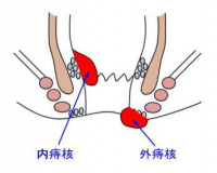 一些误导人群的痔疮知识！