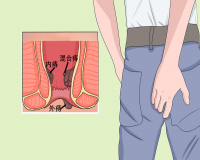 得了痔疮怎样治疗?