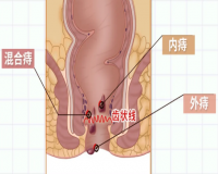 如何做好痔疮的预防?