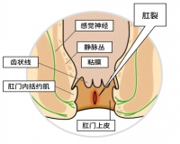 肛裂患者的护理措施？