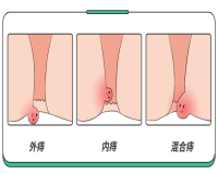 为什么痔疮有的人痛，有的人不痛呢?答案出乎意料……