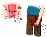 患痔疮的因素?