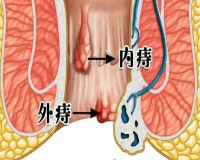 痔疮自测：看看你被痔疮“盯”上了吗?