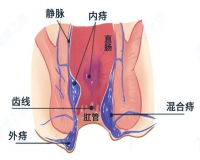 如何判断是否患有混合痔?