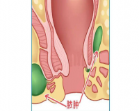 肛周脓肿会自愈吗?