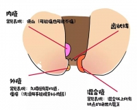 痔疮，到底是什么样的存在?