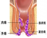 痔疮外痔肉球怎么消除?