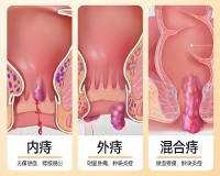 关于痔疮的样子?