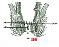 如何预防肛裂?