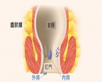 便血未必是痔疮发作?