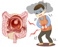 肠息肉到底是什么?