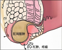 肛周脓肿的症状表现?