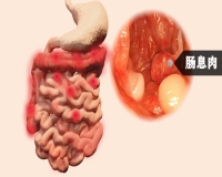 直肠息肉严重吗?