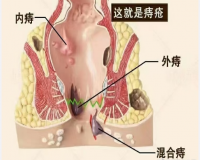 痔疮，无法言说的痛?