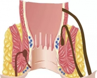 患了肛窦炎都有哪些症状?
