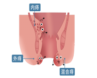 怎么就得了痔疮?