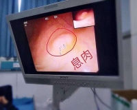直肠息肉是什么意思?