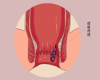 痔疮犯了会有的症状?