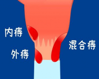 十人九痔该如何预防?