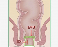 肛门齿状线具体指什么？