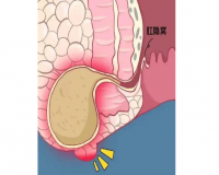 肛瘘的症状?