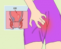 痔疮有什么常见症状?