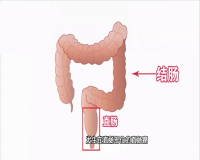 直肠炎怎么预防？