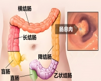 结肠息肉症状有哪些?