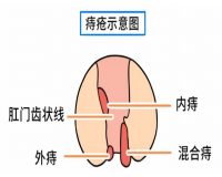 痔疮犯了坐不下?怎么解决比较好……