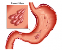 胃息肉的治疗方法有哪些？