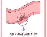 结直肠息肉是怎么形成的呢?