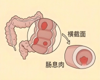直肠息肉必须做手术吗?