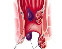 内痔的发展阶段?