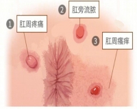 屁股差点“ 被掏空”?怎么预防肛周脓肿?