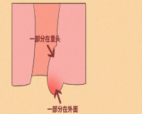 肛门上长了个包是怎么回事？