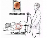 做肠镜疼吗?