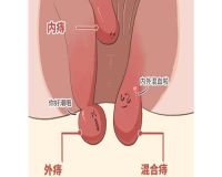 混合痔长什么样