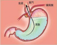 什么是胃酸?胃酸过多会怎样？