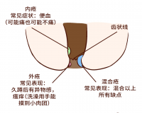 如何判断自己得了痔疮?