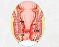 关于痔疮？