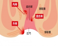 如何判断自己是不是得了痔疮?