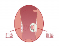 肛门长了一个小肉球怎么回事