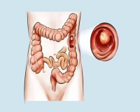 查出肠息肉，切还是不切?