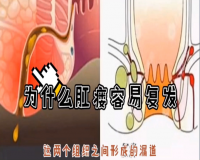 肛瘘是不是一定要手术?
