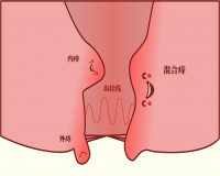 混合痔的症状?